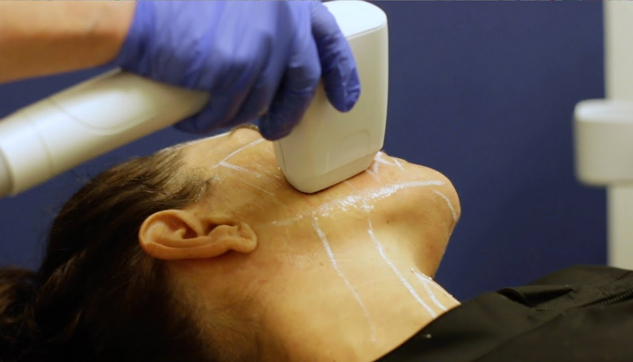 Low-Intensity Transcranial Focused Ultrasound Amygdala Neuromodulation: Target Engagement and Early Clinical Evaluation